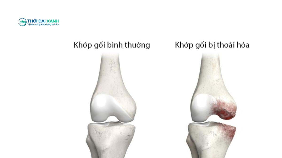 Thoái hóa khớp gối là một bệnh lý mạn tính tiến triển, đặc trưng bởi tình trạng tổn thương và mòn dần sụn khớp, kèm theo thay đổi ở xương dưới sụn, màng hoạt dịch, dây chằng và cơ quanh khớp.