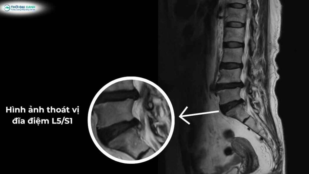 Hình hình ảnh cộng hưởng từ (MRI) thể hiện vị trí thoát vị đĩa đệm L5/S1.