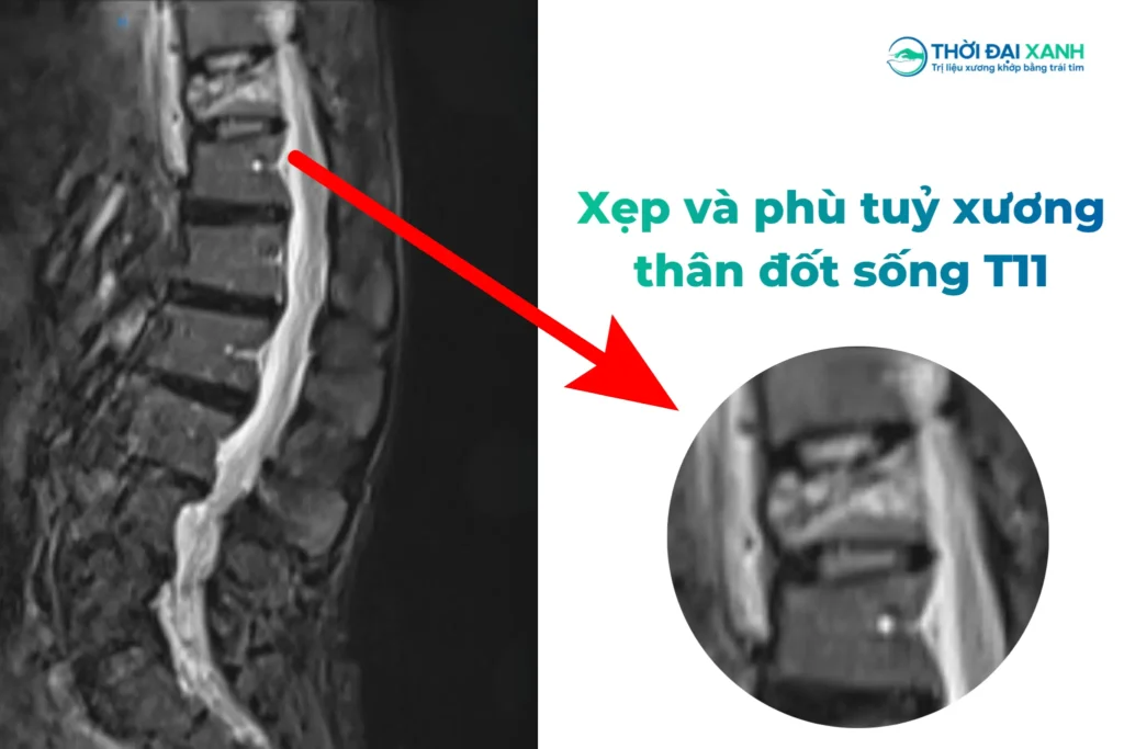Hình ảnh X-Quang cho thấy chú Trường bị xẹp và phù tuỷ xương thân đốt sống T11.
