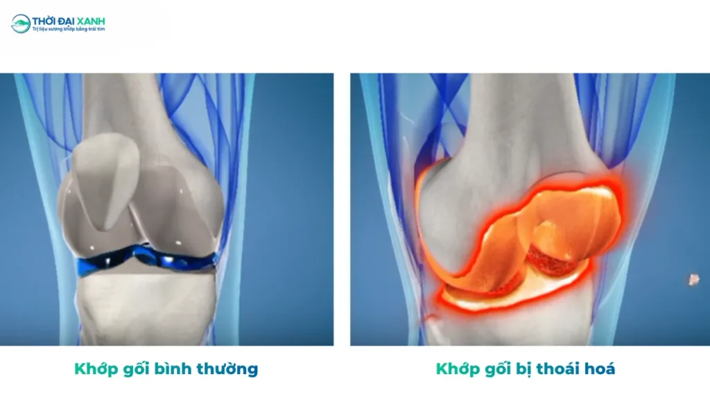 Hình ảnh minh hoạ khớp gối bình thường và khớp gối bị thoái hoá.
