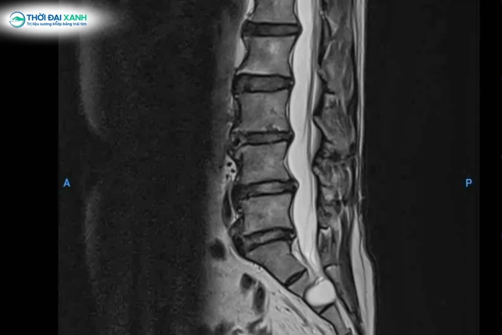 Phim chụp MRI cho thấy cô Toan bị thoát vị 3 tầng, trượt đốt sống L5, nguy cơ liệt hai chân.
