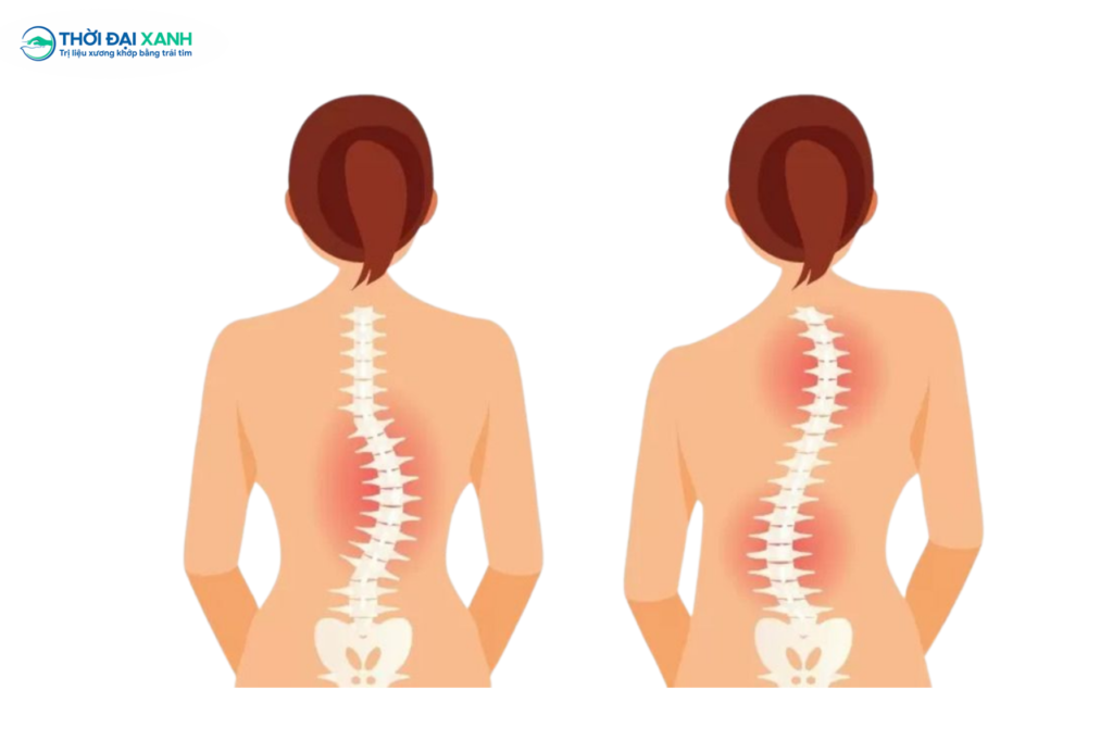 Nhiều người nghĩ dáng đi lệch hay vai cao thấp chỉ là thói quen, nhưng đó lại là những dấu hiệu sớm của cong vẹo cột sống.