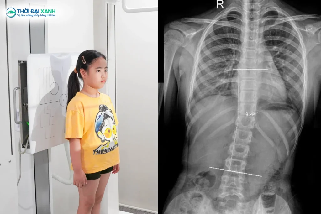 Sự thay đổi nội tiết tố và cấu trúc xương mềm mại hơn ở phái nữ khiến các bé gái dễ bị cong vẹo cột sống học đường hơn bé trai.