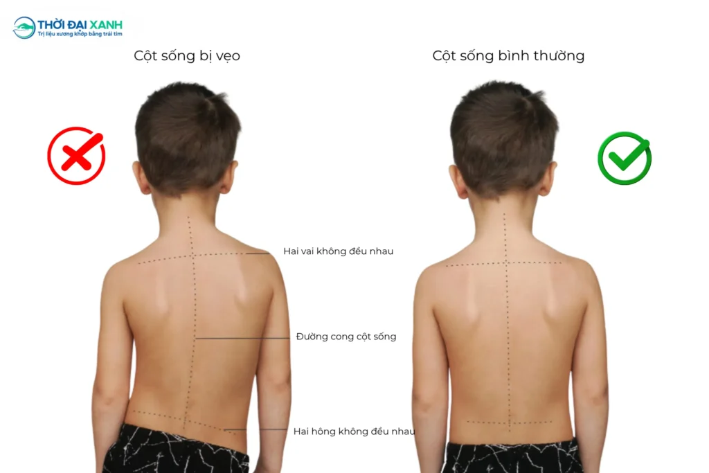 Việc nhận biết sớm các dạng vẹo cột sống thường gặp là bước đầu tiên quan trọng để bảo vệ hệ xương khớp cho chính bạn và người thân.