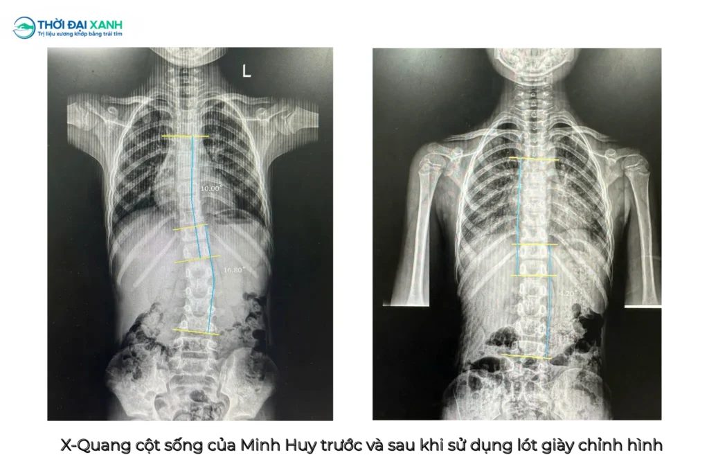 X-Quang cột sống của Minh Huy trước và sau khi sử dụng lót giày chỉnh hình tại Thời Đại Xanh.
