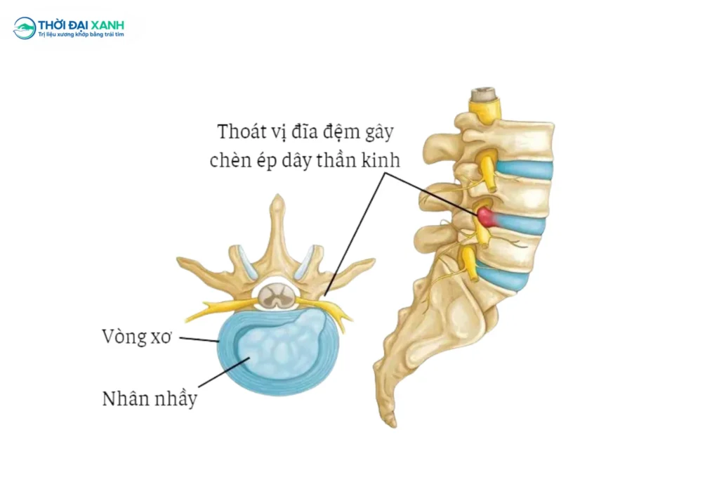 Thoát vị đĩa đệm không chỉ gây ra những cơn đau nhức đơn thuần mà còn là rào cản lớn đối với khả năng vận động và chất lượng cuộc sống.