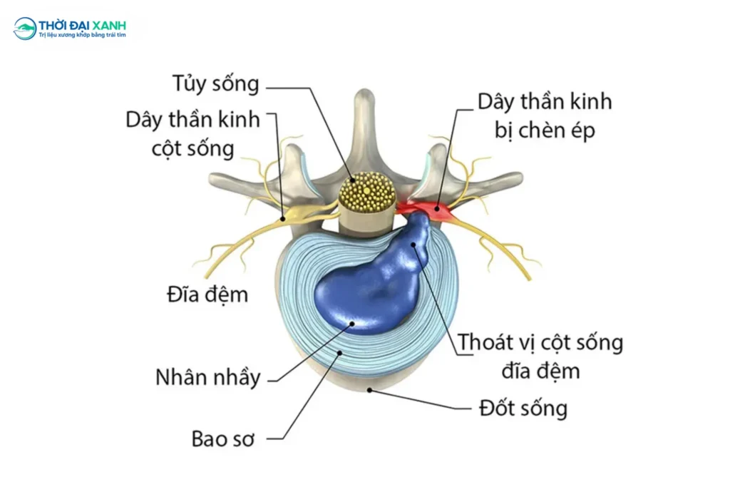Thoát vị đĩa đệm là hiện tượng một hoặc nhiều đĩa đệm nằm giữa các đốt sống lưng và cổ trượt ra khỏi vị trí ban đầu gây chèn ép lên tủy sống và các dây thần kinh trong ống sống.