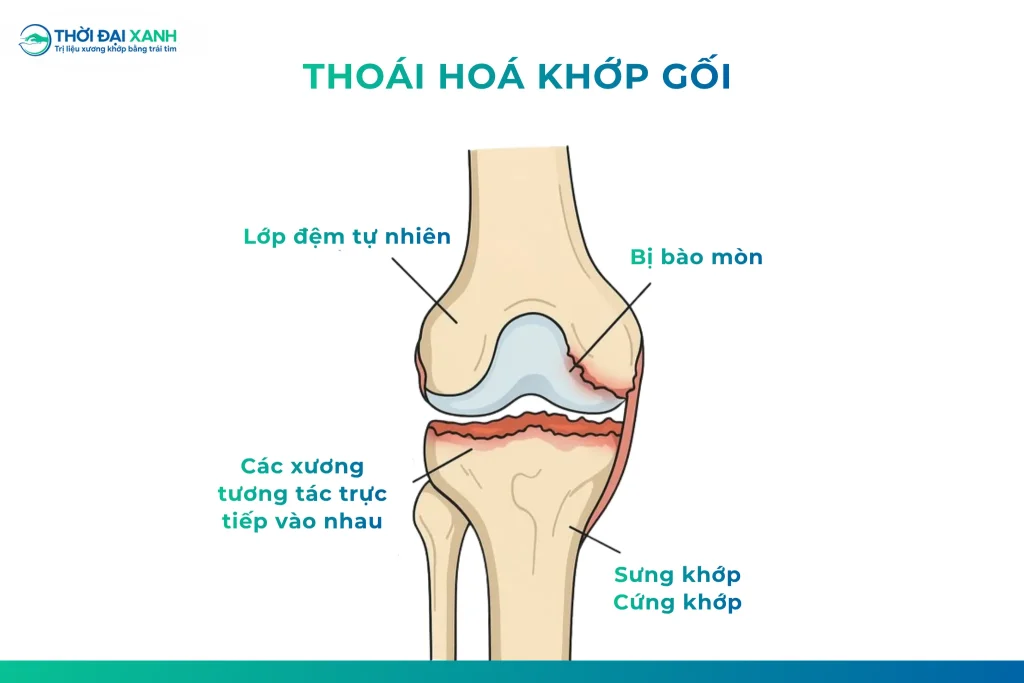 Thoái hoá khớp gối là tình trạng tổn thương mãn tính xảy ra khi lớp sụn bọc đầu xương bị mài mòn, nứt vỡ và mỏng dần, đi kèm với sự biến đổi cấu trúc của xương dưới sụn.