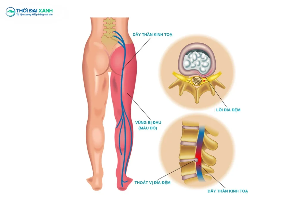 Khối nhân nhầy thoát vị chèn ép nghiêm trọng lên rễ thần kinh tọa — một biến chứng thoát vị đĩa đệm điển hình gây ra các cơn đau buốt lan tỏa xuống chi dưới.
