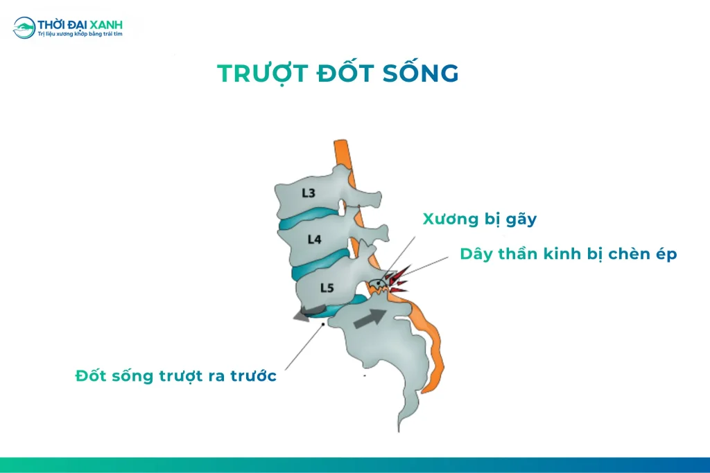 Trượt đốt sống là tình trạng một đốt sống bị dịch chuyển ra phía trước hoặc phía sau so với đốt sống ngay phía dưới.