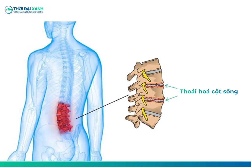 Thoái hóa cột sống thực chất là quá trình sụn khớp bị bào mòn và đĩa đệm giảm chấn do áp lực lâu ngày.
