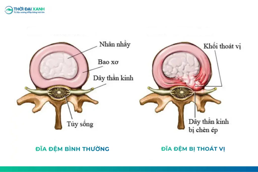 Đĩa đệm bình thường và đĩa đệm bị thoát vị khi nhìn từ trên xuống (theo mặt cắt ngang).