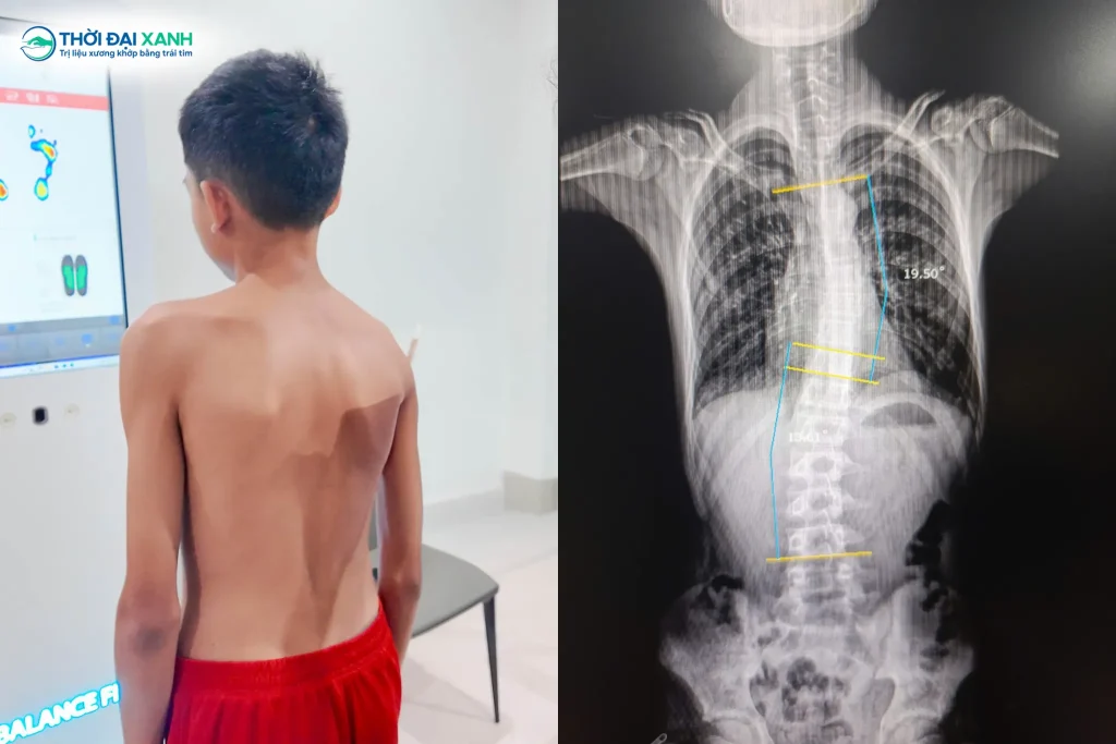 Vẹo cột sống là thuật ngữ y khoa dùng để mô tả tình trạng cột sống bị lệch sang một bên vượt quá 10 độ so với trục thẳng tự nhiên của cơ thể.