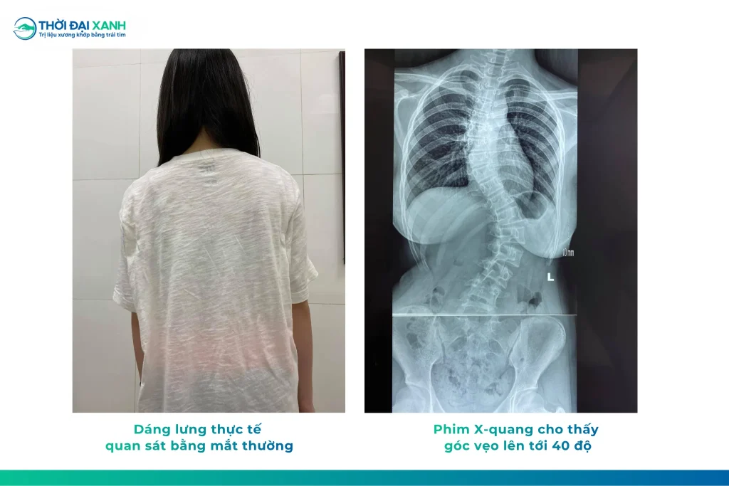 Vẹo cột sống có di truyền không? Giải đáp từ góc nhìn y khoa về yếu tố di truyền, nguy cơ tiến triển và khả năng tự khỏi của vẹo cột sống.
