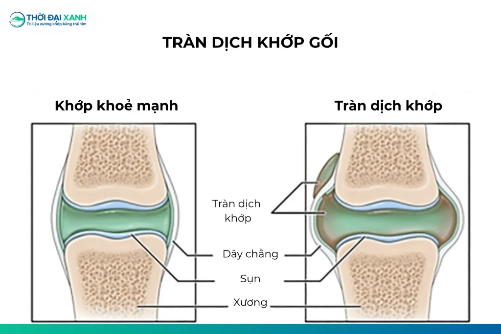 Tràn dịch khớp gối là tình trạng lượng dịch trong khớp gối tăng bất thường. Tình trạng này sẽ khiến đầu gối bị sưng phù và đau nhức.