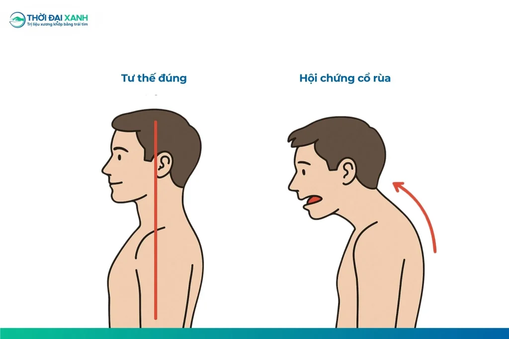 Hội chứng cổ rùa là tình trạng đầu nhô ra trước quá mức so với vai, thường gặp ở người có thói quen cúi đầu sử dụng điện thoại, máy tính hoặc ngồi làm việc sai tư thế trong thời gian dài.