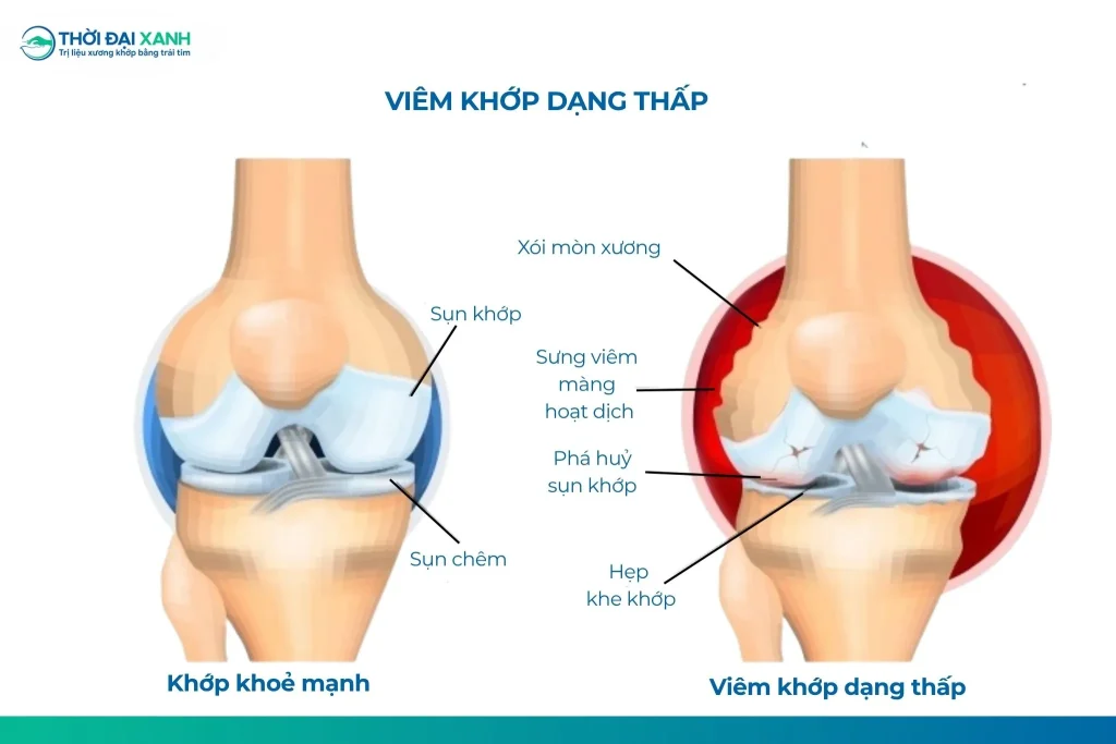 Viêm khớp dạng thấp là bệnh lý tự miễn mạn tính với các biểu hiện tại khớp, ngoài khớp và toàn thân ở nhiều mức độ khác nhau.