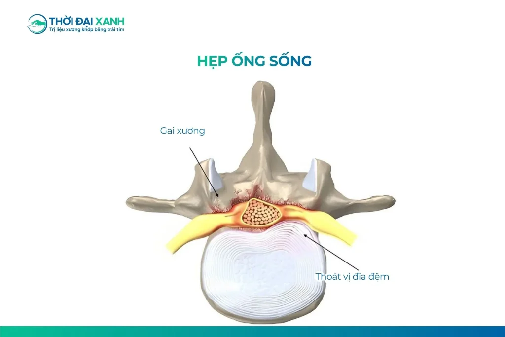 Sự hình thành gai xương từ thân đốt sống có thể là nguyên nhân gây hẹp ống sống