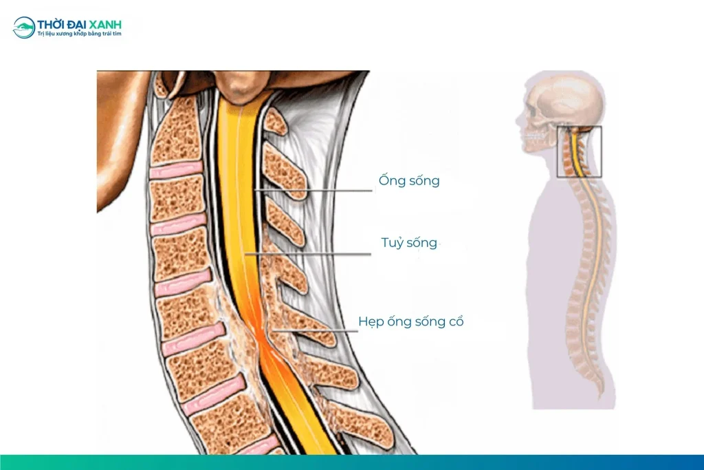 Hẹp ống sống ở cổ có thể gây ra tê liệt, yếu ở tay, chân, bàn chân hoặc cánh tay, đau mỏi cổ, rối loạn đại tiểu tiện.