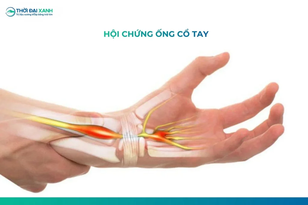 Hội chứng ống cổ tay (hay hội chứng đường hầm cổ tay) xảy ra do dây thần kinh giữa bị ép vào khi nó đi qua ống cổ tay.