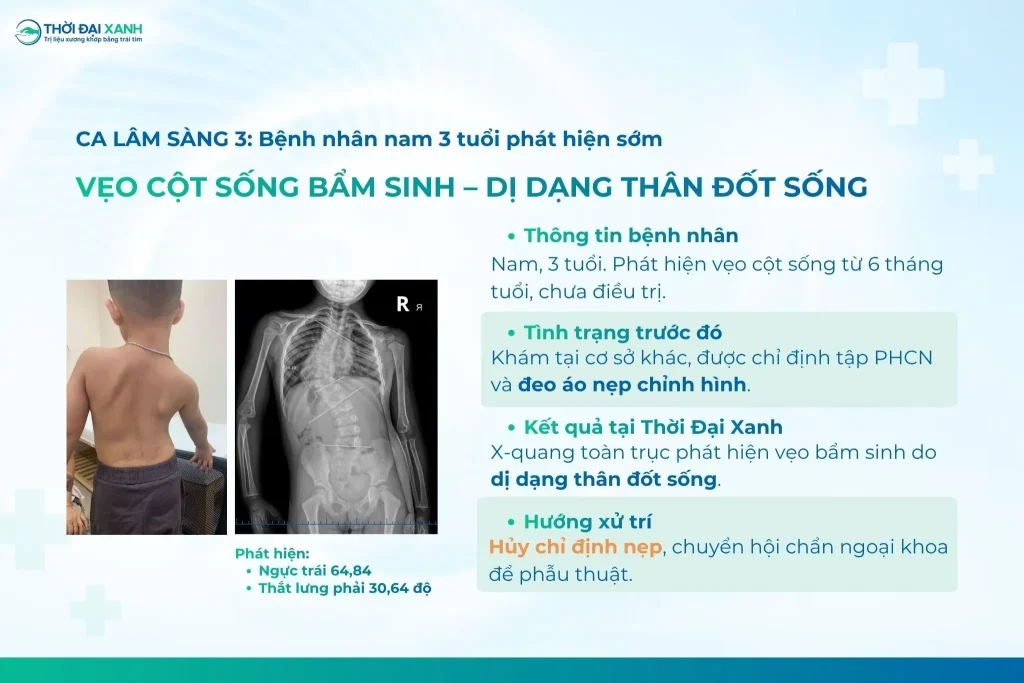 Kết quả phim chụp X-Quang cho thấy cột sống toàn trục vẹo trái đoạn ngực - thắt lưng từ T4 đến L1 với độ lệch góc 64.84 độ.