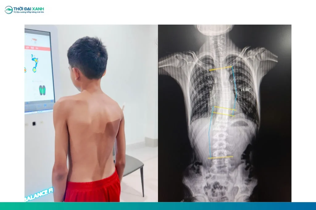Cong vẹo cột sống là một thuật ngữ mô tả những đường cong của cột sống sang phía bên lớn hơn 10 độ so với trục cơ thể.