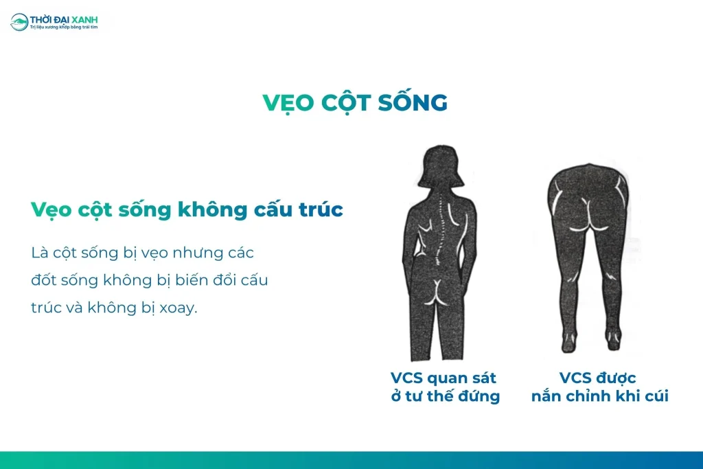 Là cột sống bị vẹo nhưng các đốt sống không bị biến đổi cấu trúc và không bị xoay.