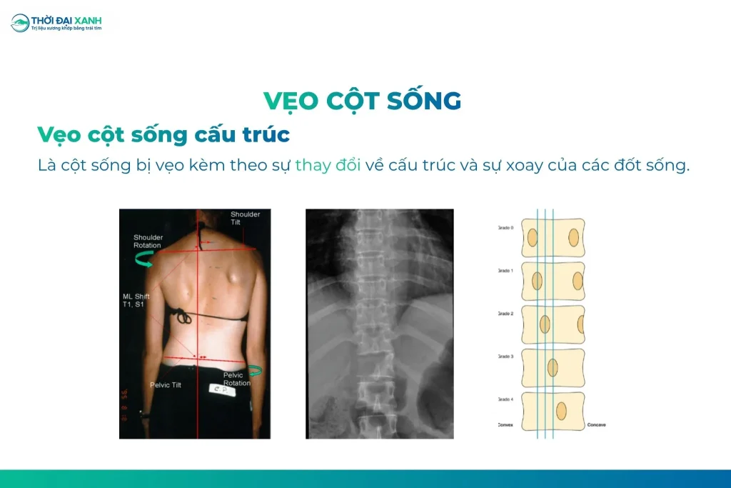 Cong vẹo cột sống cấu trúc là cột sống bị vẹo kèm theo sự thay đổi về cấu trúc và sự xoay của các đốt sống. 