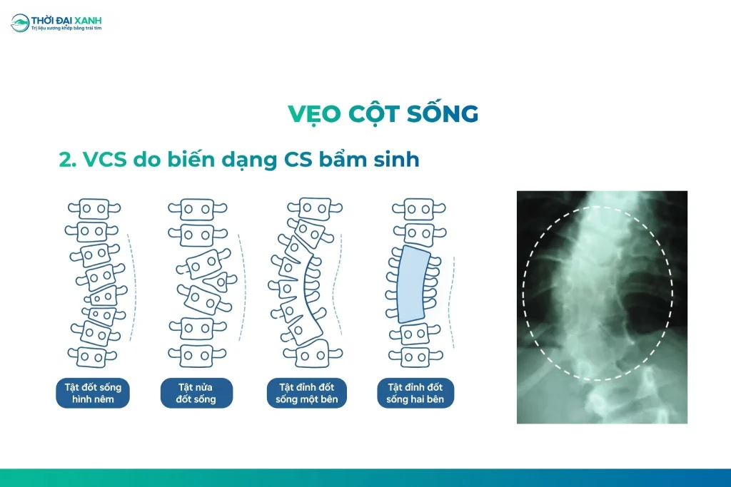Cong vẹo cột sống bẩm sinh có nguyên nhân do rối loạn trong tạo hình hay phân đoạn các đốt sống trong thời kỳ bào thai.