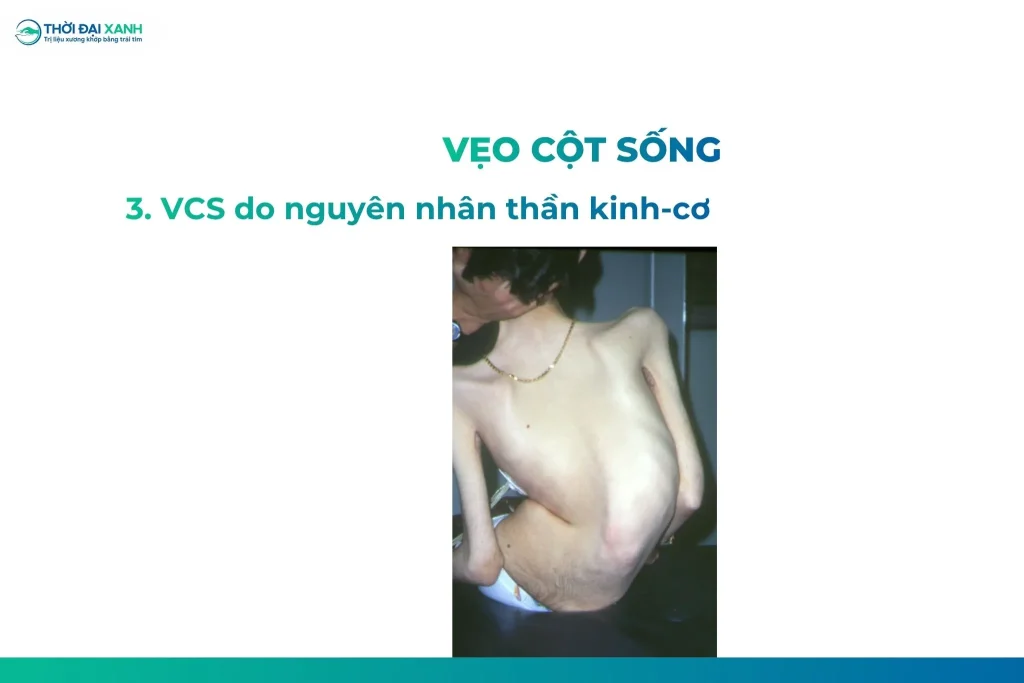 Vẹo cột sống do bệnh thần kinh cơ: là tình trạng vẹo cột sống gây ra bởi các bất thường của tổ chức thần kinh và cơ.