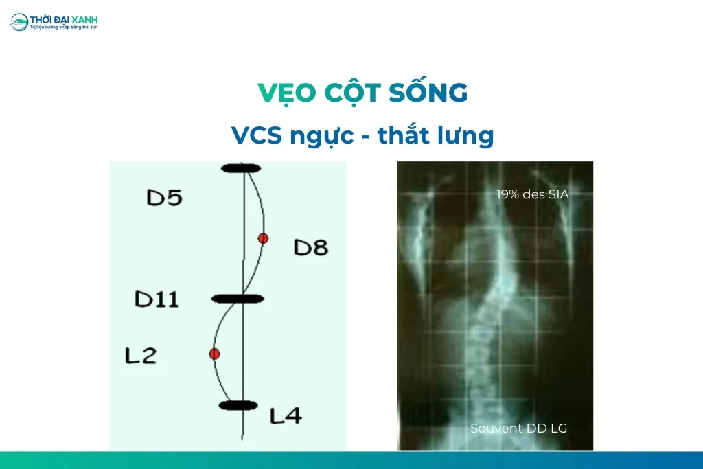 Tùy thuộc vào vị trí vẹo trên giải phẫu, cong vẹo cột sống vô căn được chia thành 6 loại vị trí đường cong khác nhau.