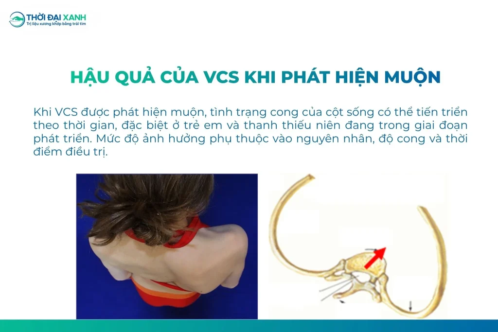Khi cong vẹo cột sống được phát hiện muộn, tình trạng cong của cột sống có thể tiến triển theo thời gian, đặc biệt ở trẻ em và thanh thiếu niên đang trong giai đoạn phát triển. 