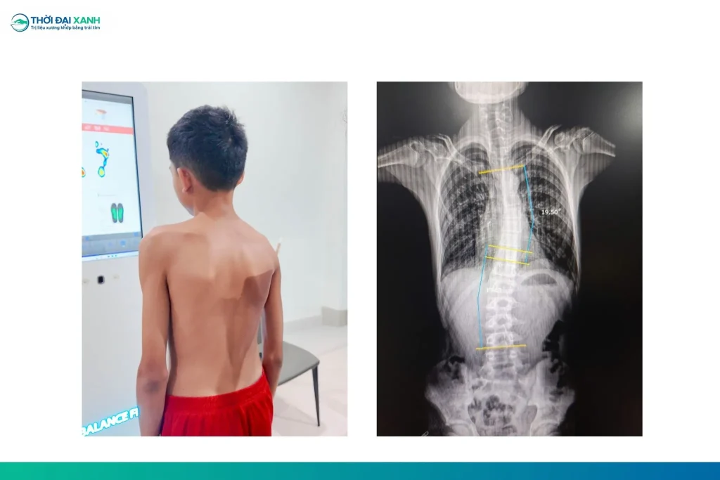 Cong vẹo cột sống học đường dễ bị che lấp bởi sự phát triển thể chất nhanh chóng. Sự chủ quan từ gia đình có thể vô tình tước đi "giai đoạn vàng" để điều trị bảo tồn.