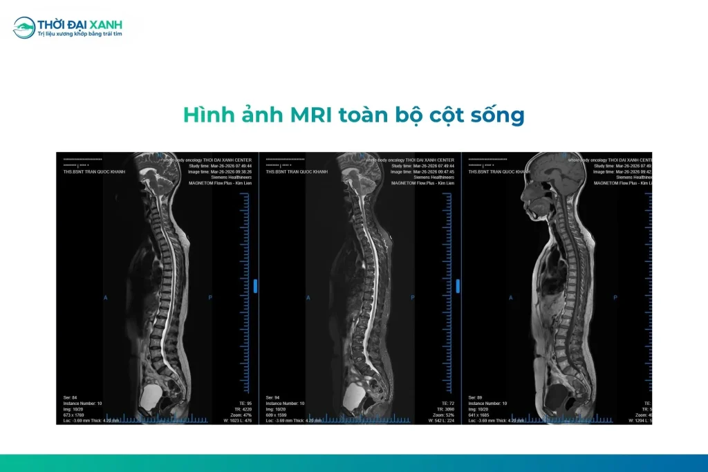 Hình ảnh chụp MRI toàn bộ cột sống.