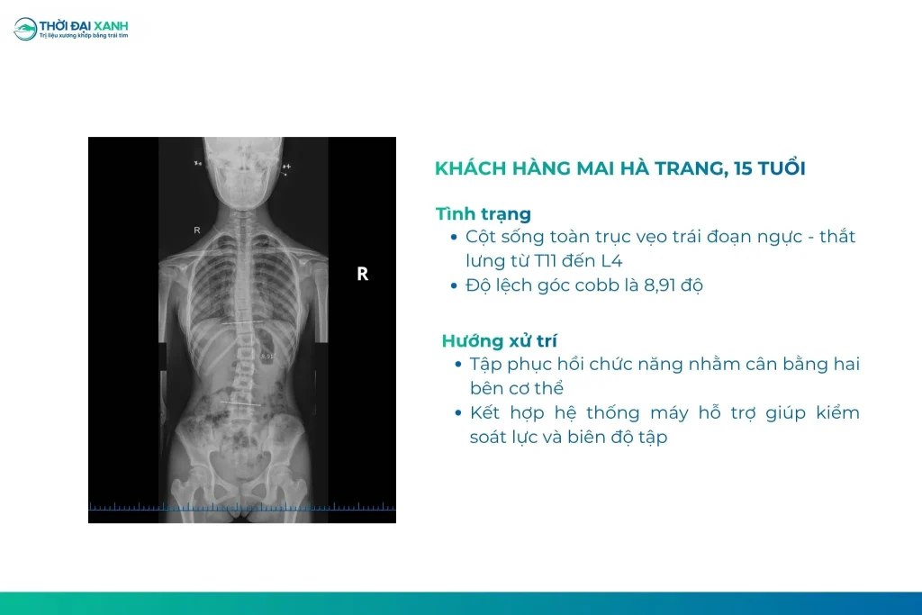 Tình trạng của Hà Trang trước khi bước vào quá trình tập phục hồi chức năng cong vẹo cột sống tại Thời Đại Xanh.