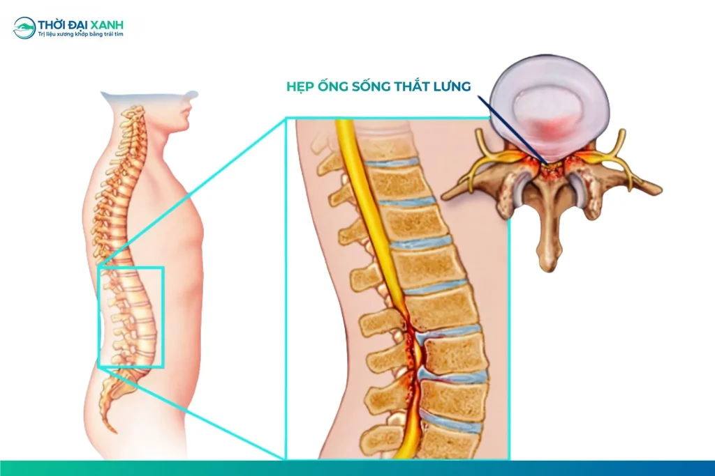 Hẹp ống sống thắt lưng là bệnh lý tiến triển âm thầm, rất dễ bị bỏ qua đằng sau các biểu hiện tê bì hay mỏi chân thường ngày.