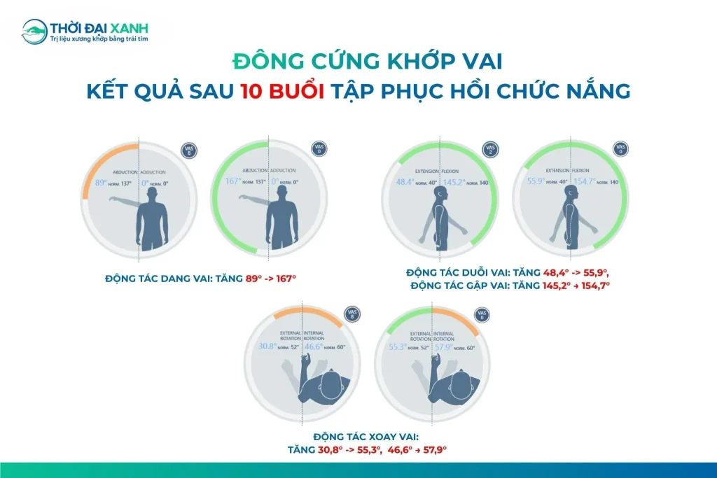 Sau 10 buổi trị liệu liên tục, các thông số kiểm tra chức năng vận động khớp vai của chú Toản đã ghi nhận sự cải thiện rõ rệt.
