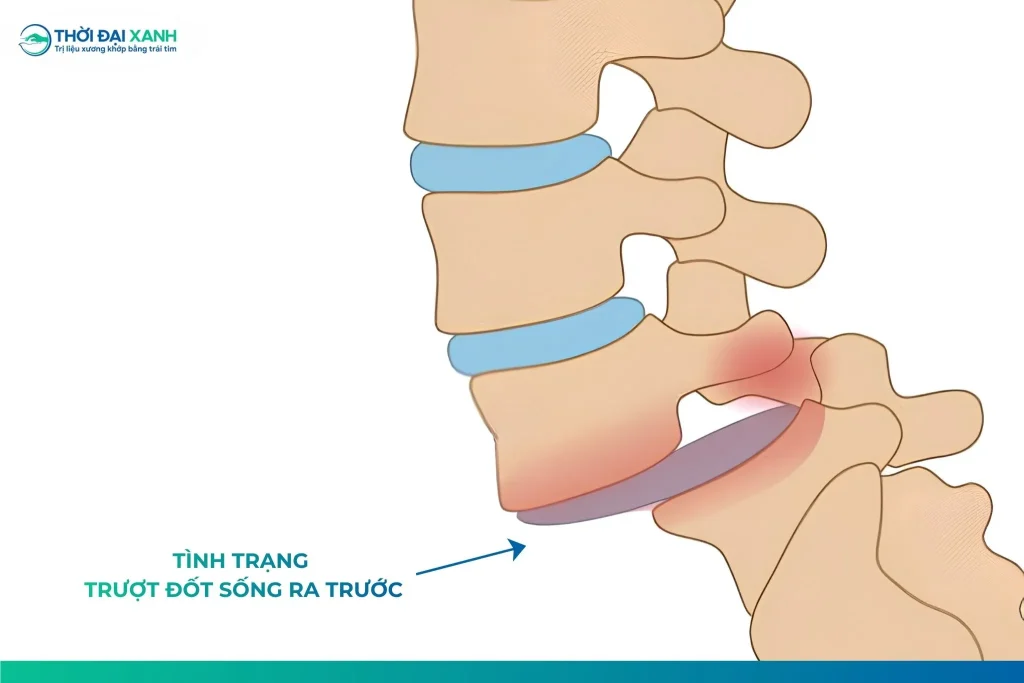 Trượt đốt sống là tình trạng đặc trưng bởi sự dịch chuyển của một đốt sống so với so với đốt sống liền kề.