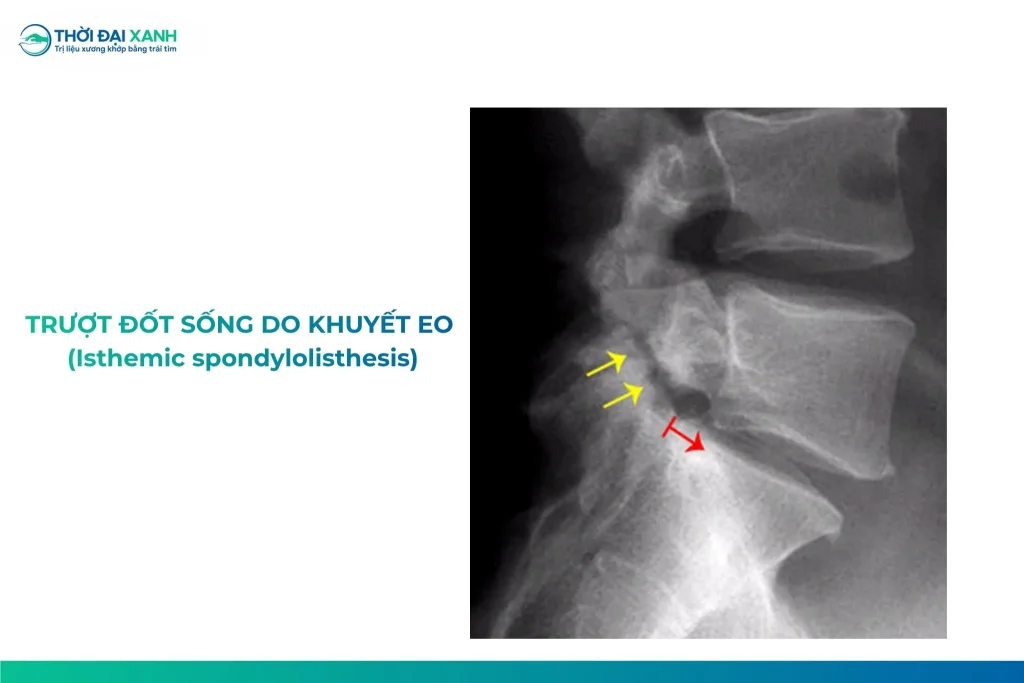 Trượt đốt sống do khuyết eo xảy ra do mất ổn định của phần mảnh cung đốt sống có thể ở 1 bên hay cả hai bên.