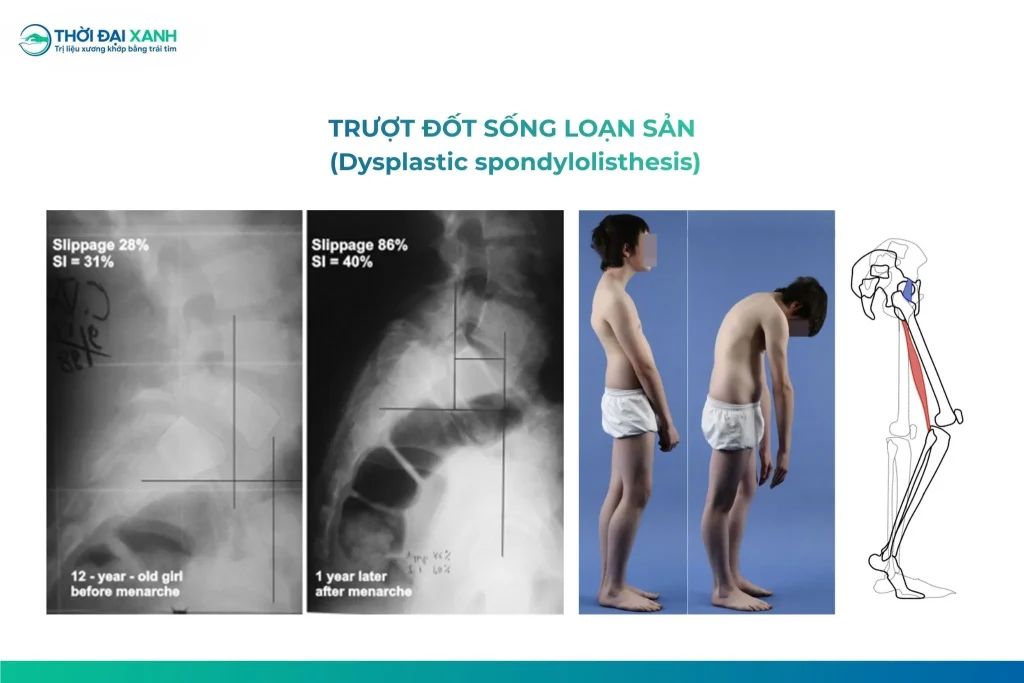 Trượt đốt sống loạn sản là một bất thường bẩm sinh xảy ra ở khớp liên mấu cột sống đoạn L5- S1. Thường xảy ra ở trẻ nữ và có liên quan đến di truyền.