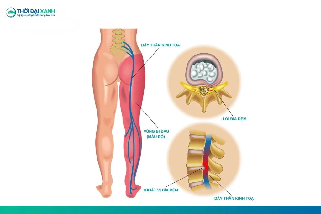 Đau thần kinh toạ là cảm giác đau dọc theo đường đi của thần kinh tọa: đau tại cột sống thắt lưng lan tới mặt ngoài đùi, mặt trước ngoài cẳng chân, mắt cá ngoài và tận ở các ngón chân.