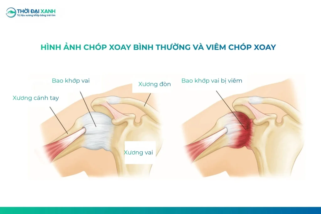 Khớp vai là khớp vận động linh hoạt nhất cơ thể, cho phép cánh tay xoay, giơ cao, đưa ra trước hay ra sau. Để khớp vai vận hành trơn tru, hệ thống gân - cơ chóp xoay giữ vai trò quan trọng.