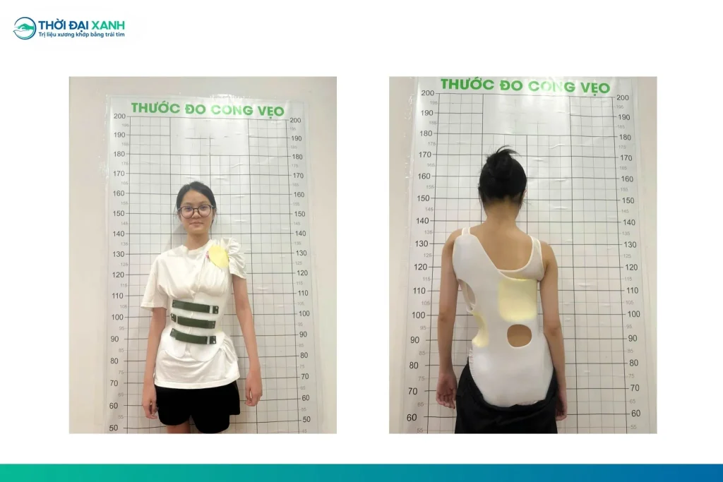 Áo nẹp chỉnh hình hỗ trợ kiểm soát tiến triển đường cong trong can thiệp vẹo cột sống ở trẻ còn tăng trưởng.