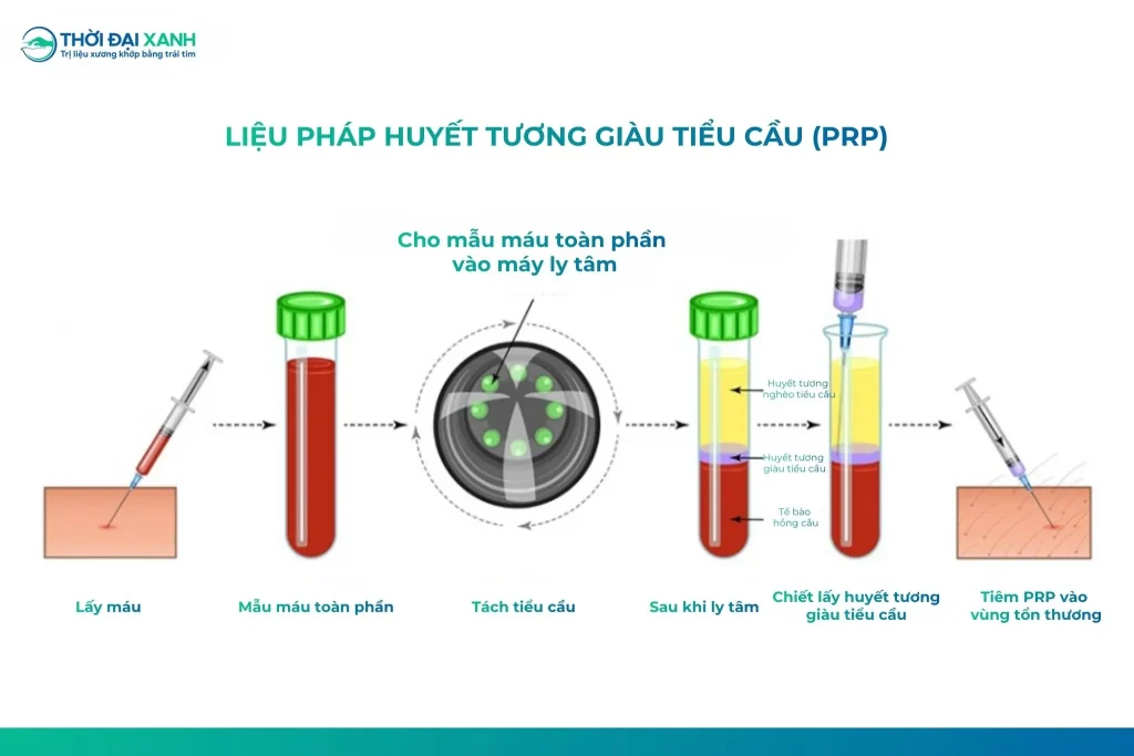Quy trình tiêm huyết tương giàu tiểu cầu ứng dụng trong điều trị viêm gân cơ chóp xoay.