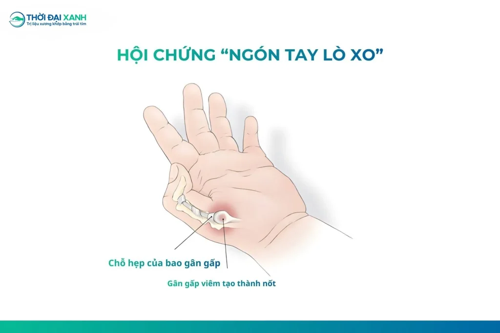 Ngón tay lò xo là tình trạng bao gân gấp của một ngón tay bị viêm, dày lên hoặc bị chít hẹp, làm cho gân gấp khó trượt qua bao gân khi gấp - duỗi.