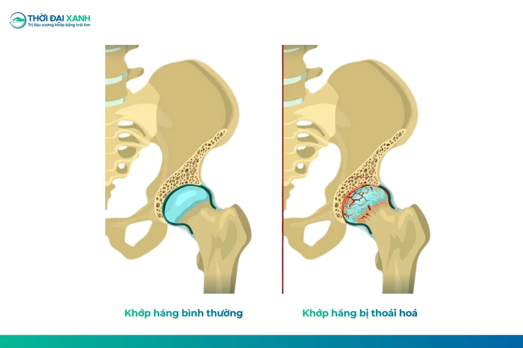 Thoái hóa khớp háng là tình trạng lớp sụn ở phần khớp háng, nơi đầu xương đùi khớp với ổ chậu bị mòn và tổn thương dần theo thời gian.