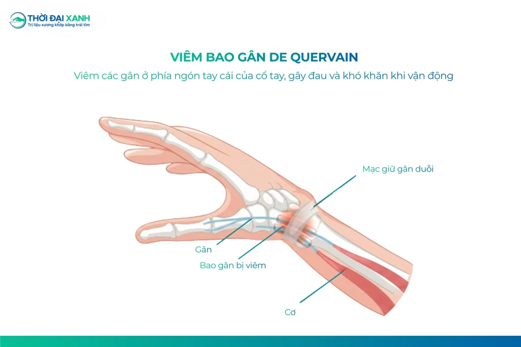 Hội chứng De Quervain là tình trạng viêm - chít hẹp của bao gân quanh hai gân chạy dọc mặt lưng cổ tay - ngón cái, gồm gân dạng dài ngón cái và gân duỗi ngón cái ngắn.