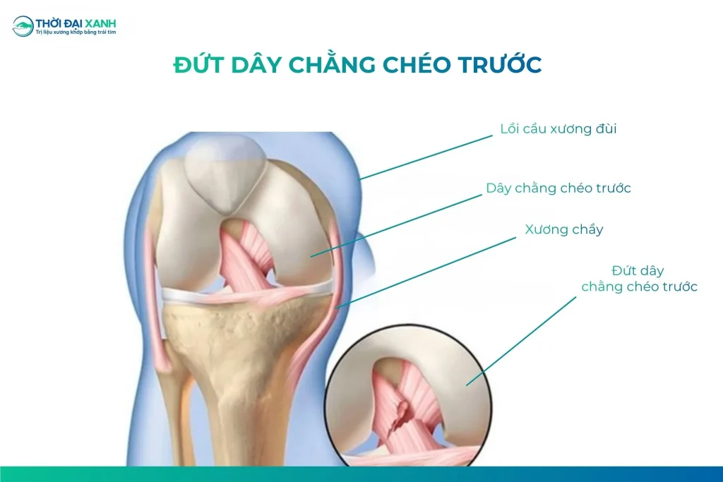 Chấn thương đứt dây chằng chéo trước là tình trạng dây chằng bị đứt một phần hoặc toàn bộ khi người bệnh thay đổi chuyển động đột ngột, vấp hoặc ngã làm dây chằng chéo bị căng.