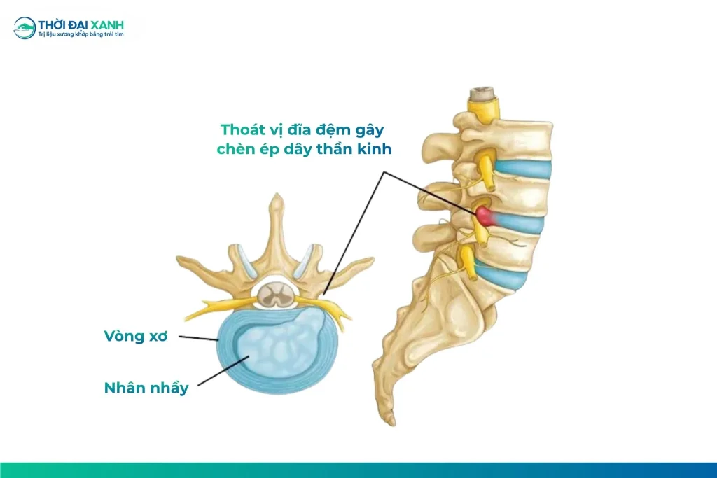 Thoát vị đĩa đệm L4–L5 chèn ép rễ thần kinh là nguyên nhân khiến chị Tuyên đau dữ dội và suy giảm nghiêm trọng khả năng vận động.