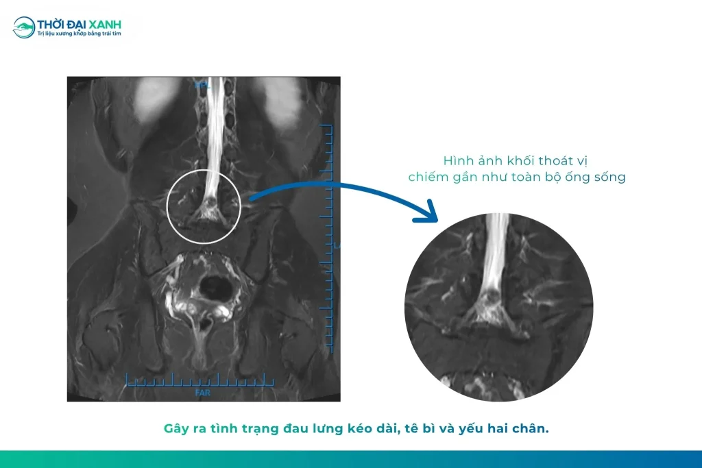 Hình ảnh MRI cho thấy anh Việt bị thoát vị đĩa đệm kích thước lớn, gây chèn ép thần kinh sau 3 năm đau lưng kéo dài.